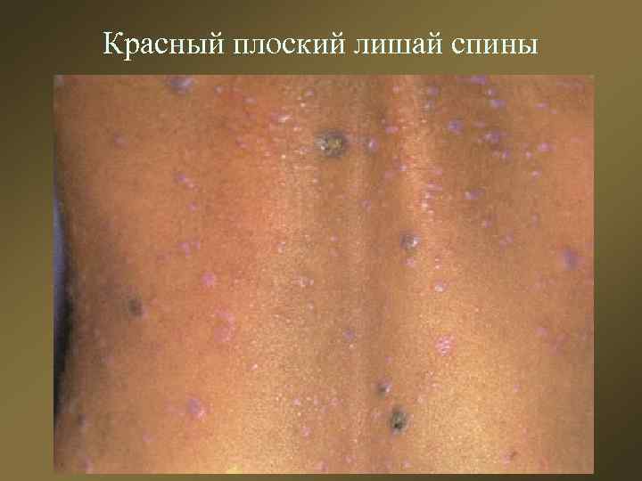 Красный плоский лишай спины 