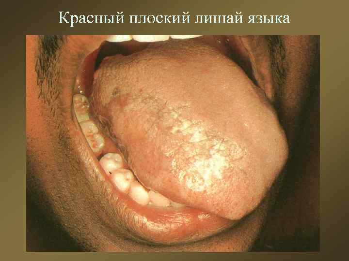 Красный плоский лишай языка 