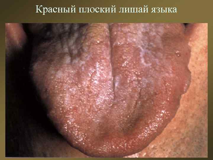 Красный плоский лишай языка 