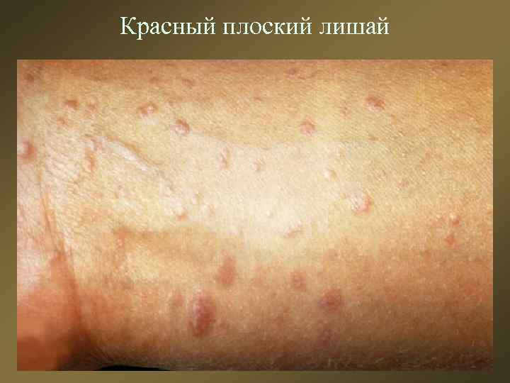 Красный плоский лишай 