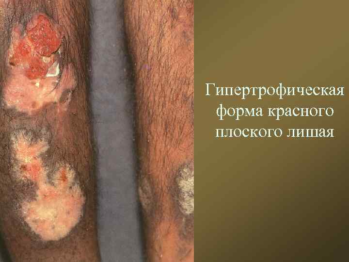 Гипертрофическая форма красного плоского лишая 