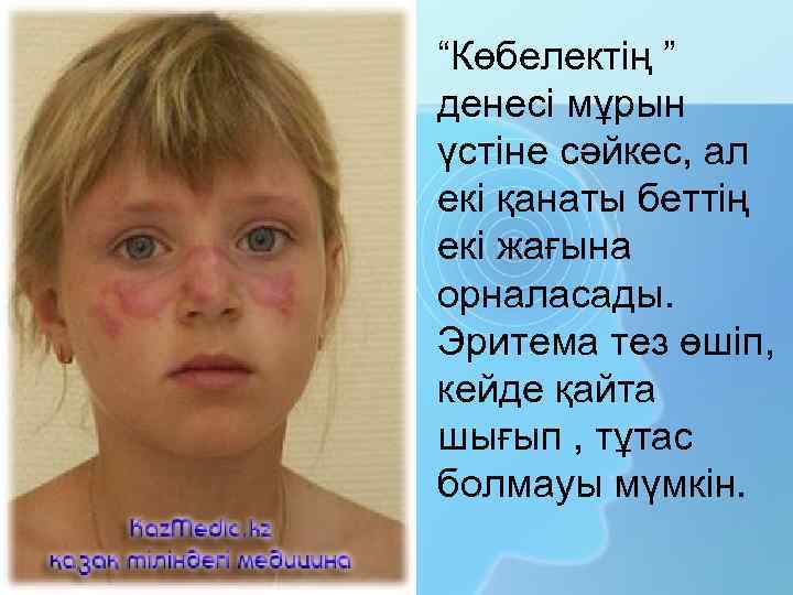 “Көбелектің ” денесі мұрын үстіне сәйкес, ал екі қанаты беттің екі жағына орналасады. Эритема