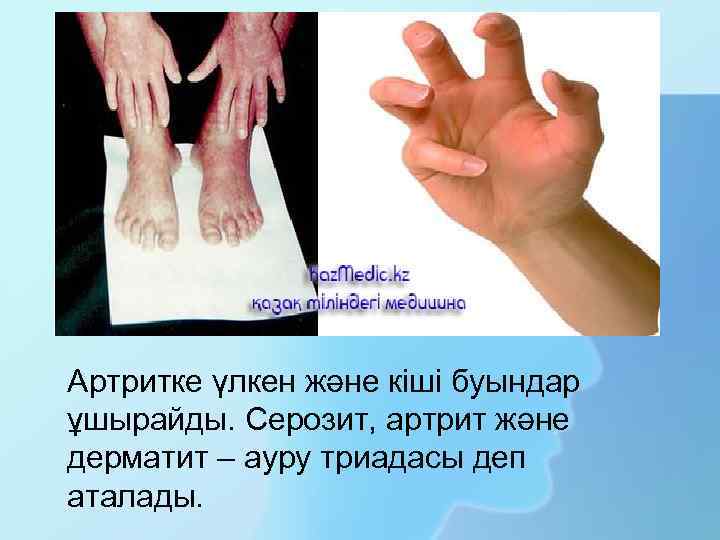Артритке үлкен және кіші буындар ұшырайды. Серозит, артрит және дерматит – ауру триадасы деп