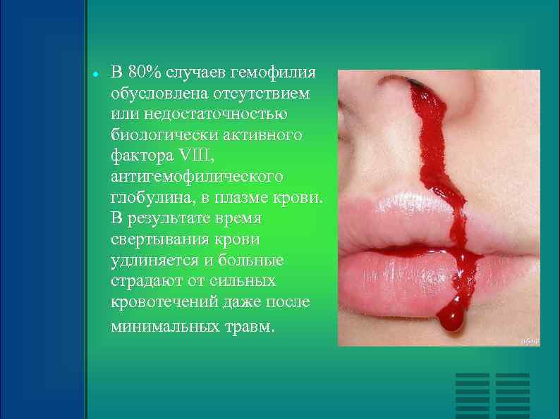  В 80% случаев гемофилия обусловлена отсутствием или недостаточностью биологически активного фактора VIII, антигемофилического