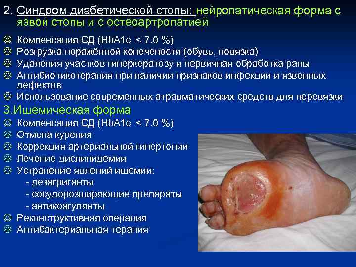 2. Синдром диабетической стопы: нейропатическая форма с язвой стопы и с остеоартропатией J J