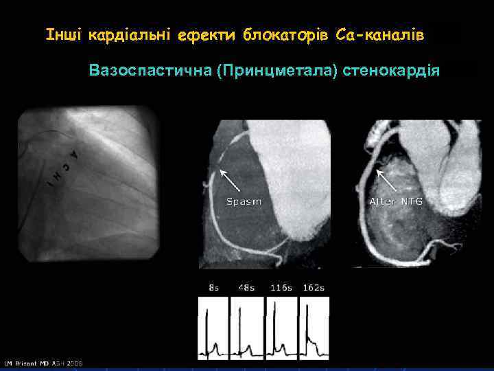 Інші кардіальні ефекти блокаторів Са-каналів Вазоспастична (Принцметала) стенокардія 