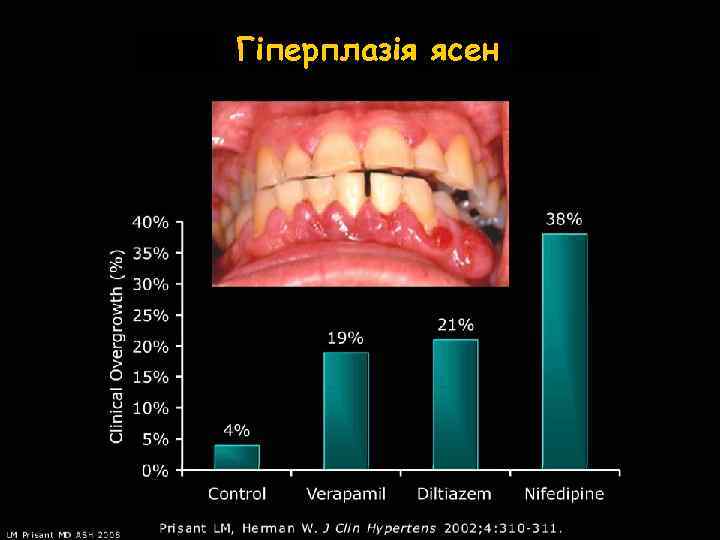 Гіперплазія ясен 