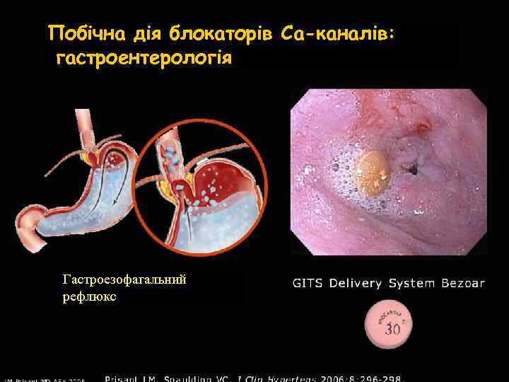 Побічна дія блокаторів Са-каналів: гастроентерологія Гастроезофагальний рефлюкс 