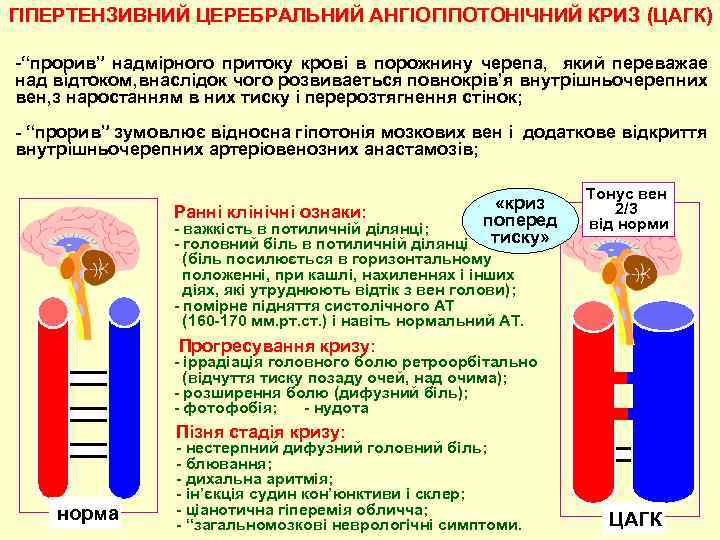 ГІПЕРТЕНЗИВНИЙ ЦЕРЕБРАЛЬНИЙ АНГIОГIПОТОНIЧНИЙ КРИЗ (ЦАГК) -“прорив” надмiрного притоку кровi в порожнину черепа, який переважае