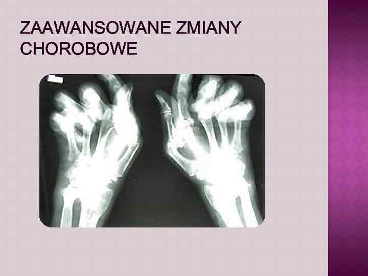 ZAAWANSOWANE ZMIANY CHOROBOWE 