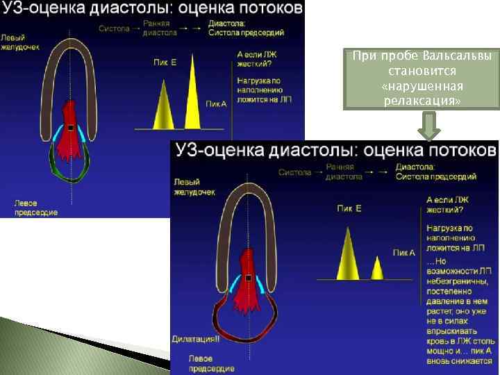 При пробе Вальсальвы становится «нарушенная релаксация» 