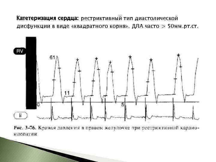 Катетеризация сердца: рестриктивный тип диастолической дисфункции в виде «квадратного корня» . ДЛА часто >