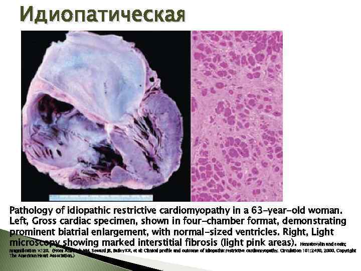 Идиопатическая Pathology of idiopathic restrictive cardiomyopathy in a 63 -year-old woman. Left, Gross cardiac