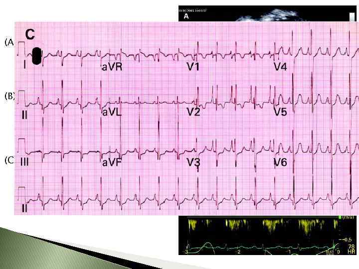 (A) Apical four-chamber view from individual H 1685 showing severe biatrial dilatation in the