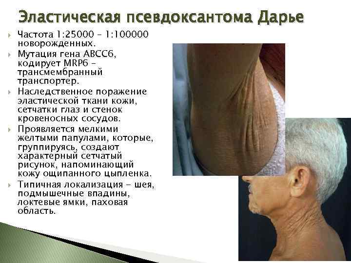 Эластическая псевдоксантома Дарье Частота 1: 25000 – 1: 100000 новорожденных. Мутация гена АВСС 6,
