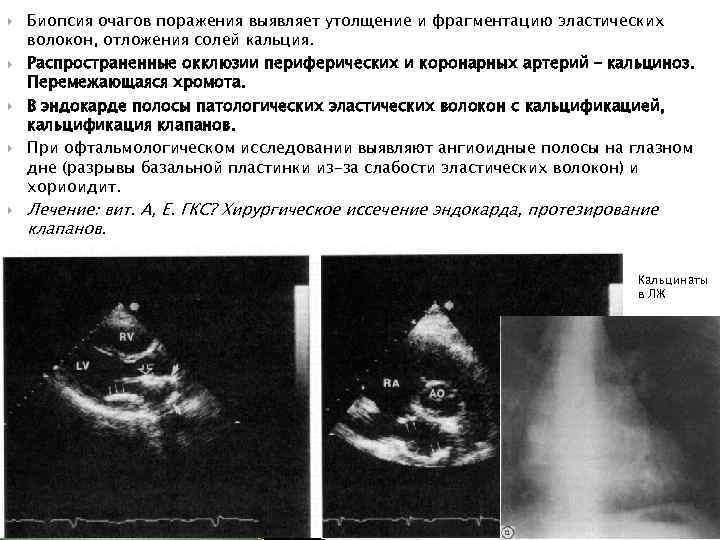  Биопсия очагов поражения выявляет утолщение и фрагментацию эластических волокон, отложения солей кальция. Распространенные