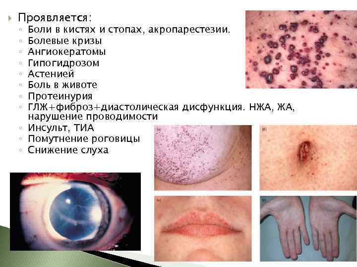  Проявляется: Боли в кистях и стопах, акропарестезии. Болевые кризы Ангиокератомы Гипогидрозом Астенией Боль