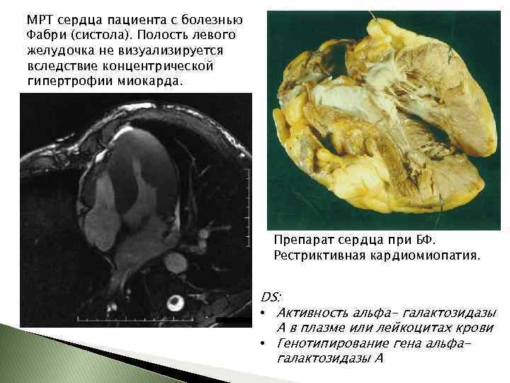 МРТ сердца пациента с болезнью Фабри (систола). Полость левого желудочка не визуализируется вследствие концентрической