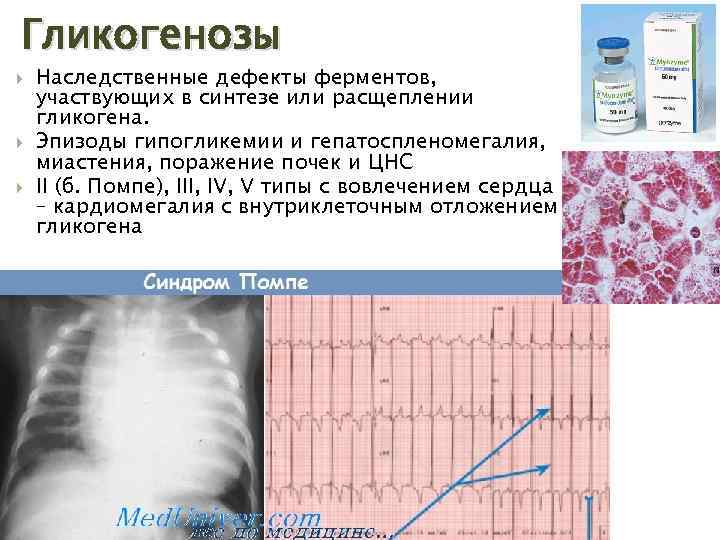 Гликогенозы Наследственные дефекты ферментов, участвующих в синтезе или расщеплении гликогена. Эпизоды гипогликемии и гепатоспленомегалия,