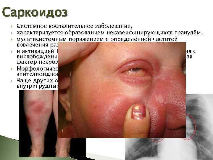 Саркоидоз Системное воспалительное заболевание, характеризуется образованием неказеифицирующихся гранулём, мультисистемным поражением с определённой частотой вовлечения