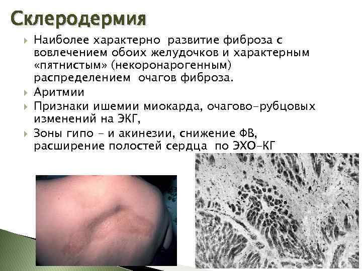 Склеродермия Наиболее характерно развитие фиброза с вовлечением обоих желудочков и характерным «пятнистым» (некоронарогенным) распределением