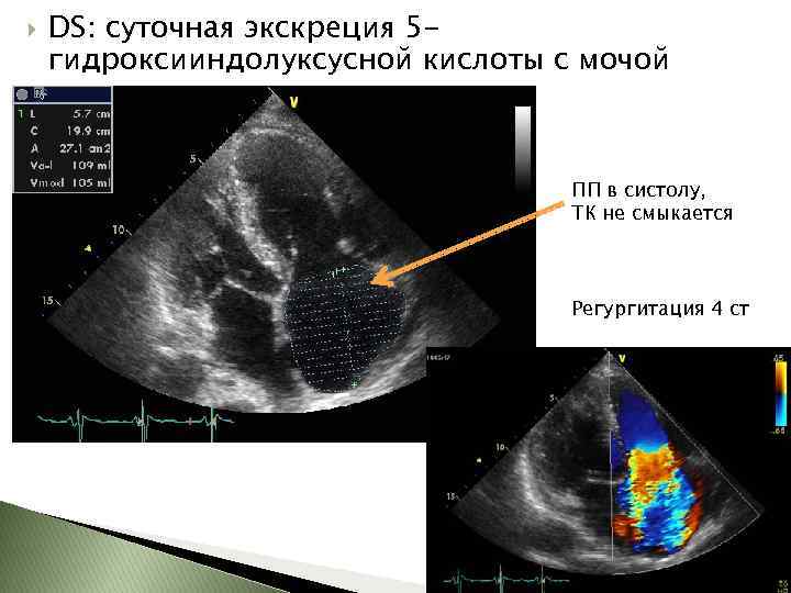  DS: суточная экскреция 5 гидроксииндолуксусной кислоты с мочой ПП в систолу, ТК не