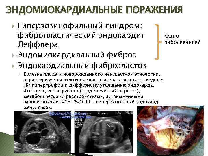 ЭНДОМИОКАРДИАЛЬНЫЕ ПОРАЖЕНИЯ Гиперэозинофильный синдром: фибропластический эндокардит Леффлера Эндомиокардиальный фиброз Эндокардиальный фиброэластоз ◦ Болезнь плода