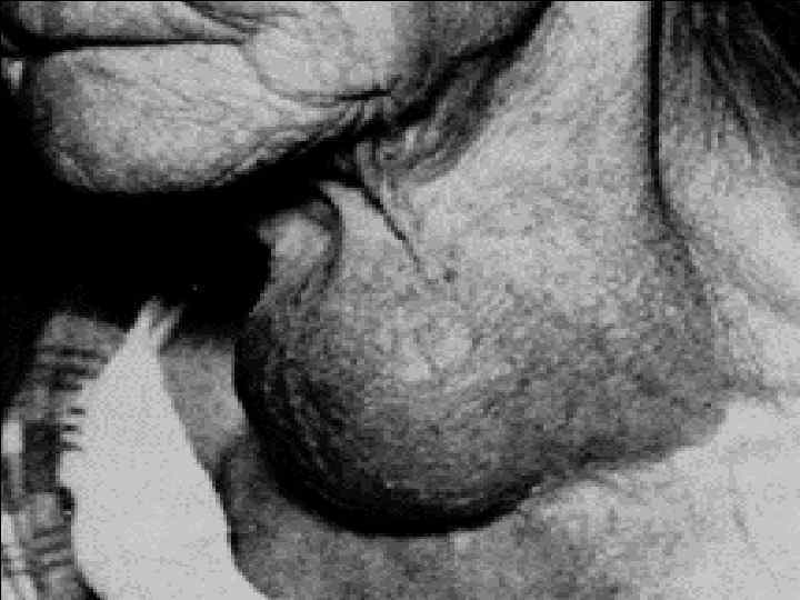 Гипофункция щитовидной железы . 