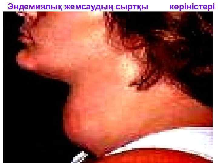 Эндемиялық жемсаудың сыртқы көріністері 