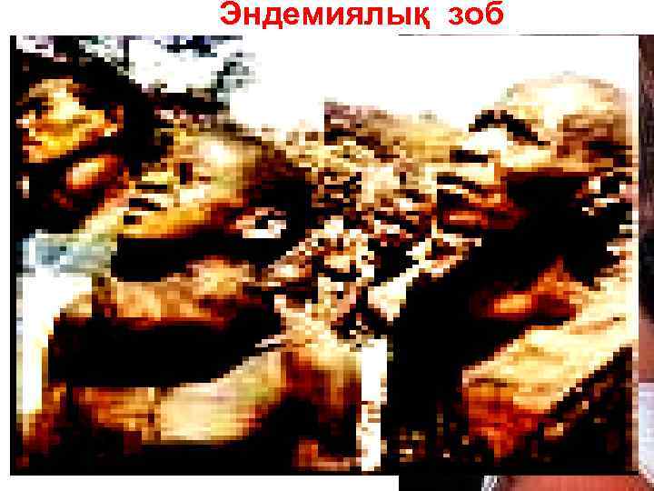 Эндемиялық зоб 