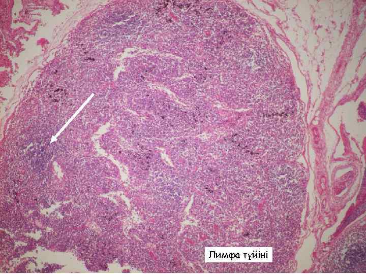 Лимфа түйіні 