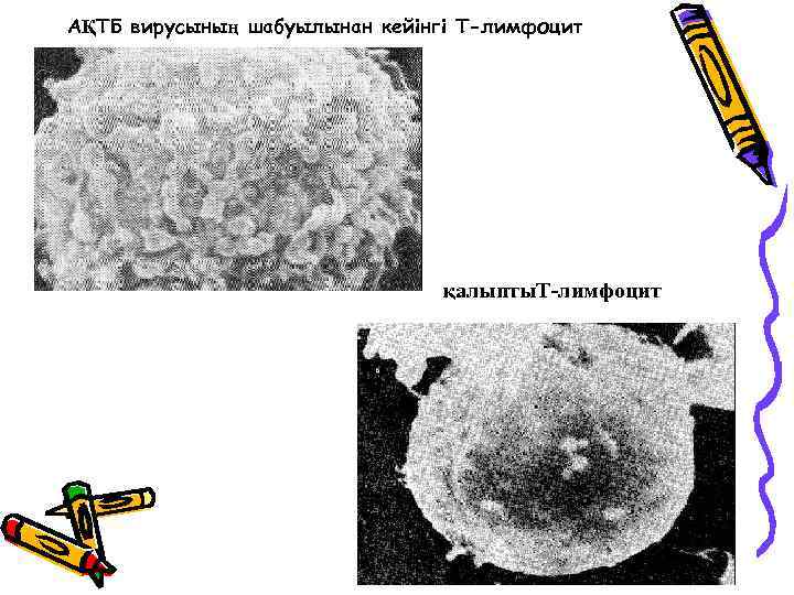 АҚТБ вирусының шабуылынан кейінгі Т-лимфоцит қалыпты. Т-лимфоцит 