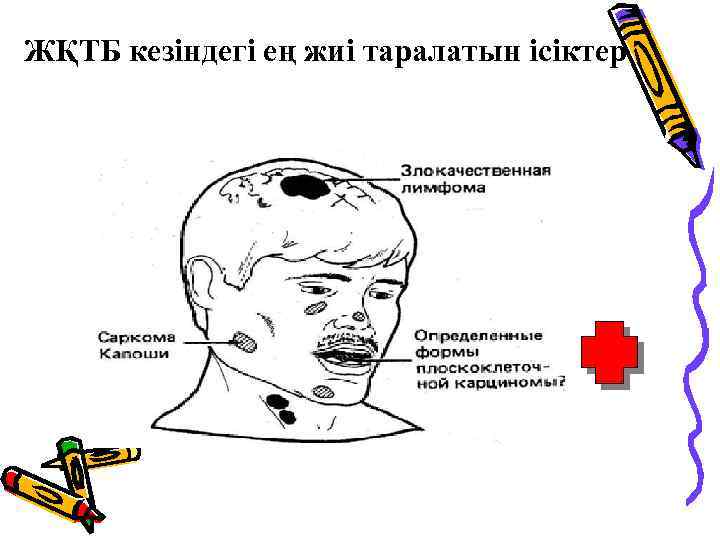 ЖҚТБ кезіндегі ең жиі таралатын ісіктер 