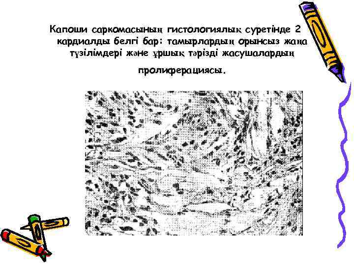 Капоши саркомасының гистологиялық суретінде 2 кардиалды белгі бар: тамырлардың орынсыз жаңа түзілімдері және ұршық