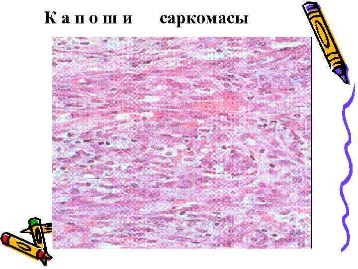 Капоши саркомасы 