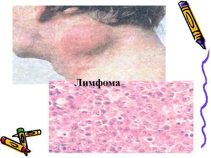 Лимфома 