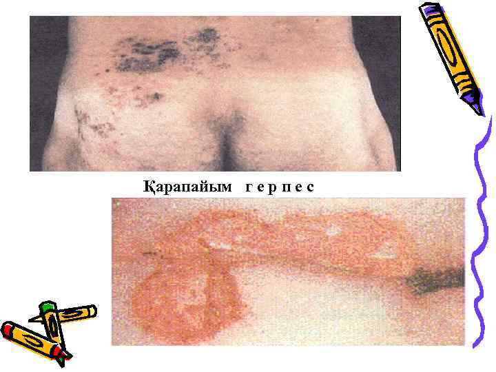 Қарапайым г е р п е с 