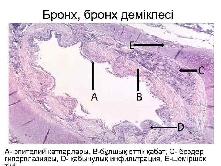 Бронх, бронх демікпесі E С А В D А- эпителий қатпарлары, В-бұлшық еттік қабат,