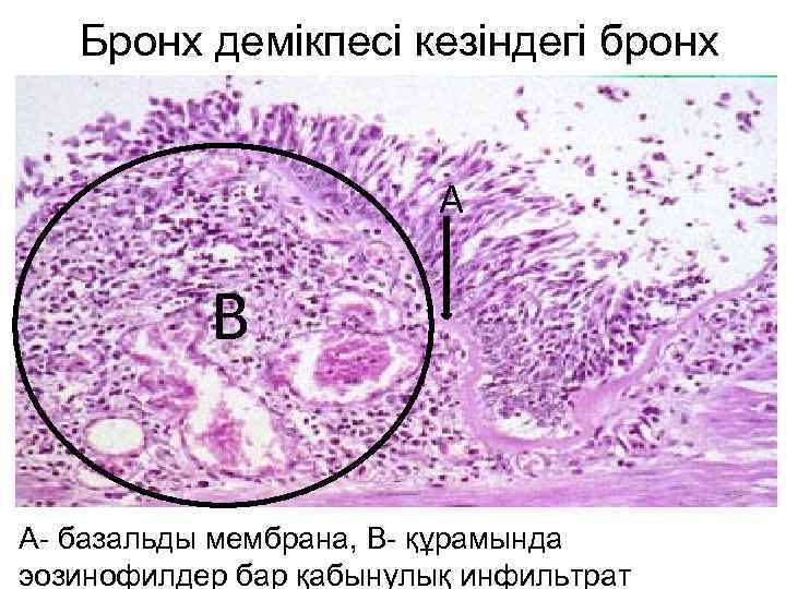 Бронх демікпесі кезіндегі бронх A B A- базальды мембрана, B- құрамында эозинофилдер бар қабынулық