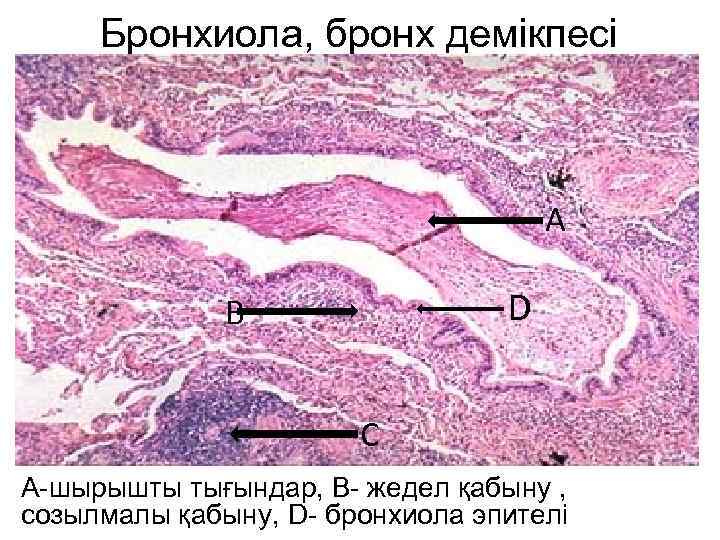 Бронхиола, бронх демікпесі А D В С А-шырышты тығындар, В- жедел қабыну , созылмалы