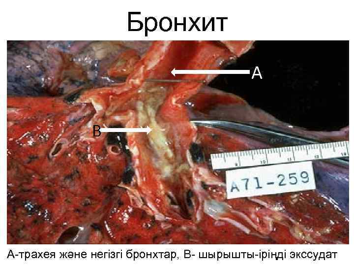 Бронхит А В А-трахея және негізгі бронхтар, В- шырышты-іріңді экссудат 