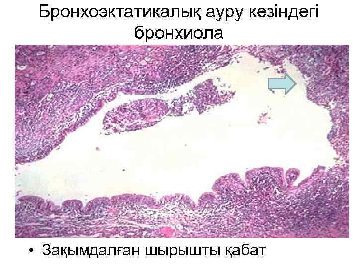 Бронхоэктатикалық ауру кезіндегі бронхиола • Зақымдалған шырышты қабат 