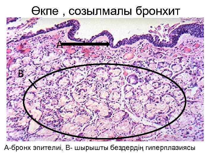 Өкпе , созылмалы бронхит А В А-бронх эпителиі, В- шырышты бездердің гиперплазиясы 