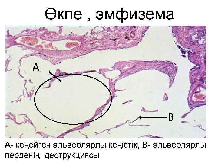 Өкпе , эмфизема А В А- кеңейген альвеолярлы кеңістік, В- альвеолярлы перденің деструкциясы 
