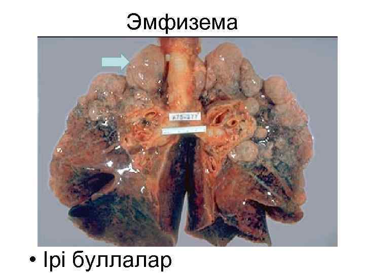 Эмфизема • Ірі буллалар 