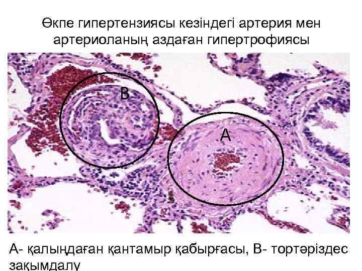 Өкпе гипертензиясы кезіндегі артерия мен артериоланың аздаған гипертрофиясы В А А- қалыңдаған қантамыр қабырғасы,