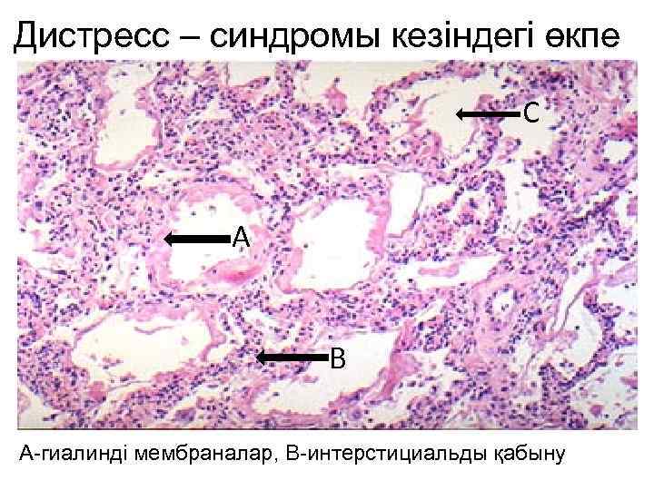 Дистресс – синдромы кезіндегі өкпе С А В А-гиалинді мембраналар, В-интерстициальды қабыну 