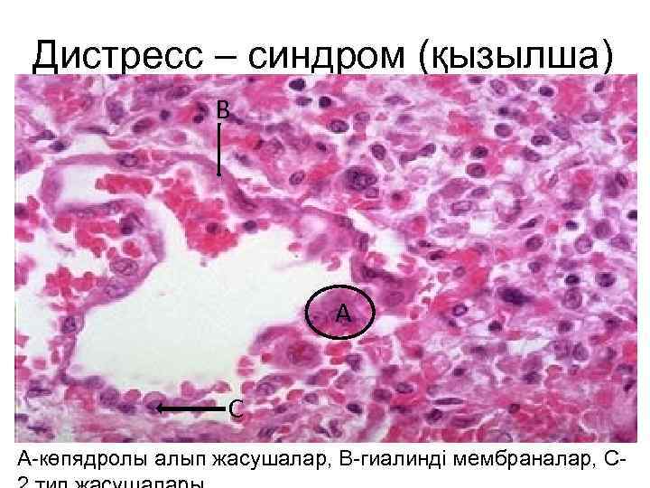 Дистресс – синдром (қызылша) В А С А-көпядролы алып жасушалар, В-гиалинді мембраналар, С- 