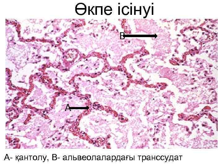 Өкпе ісінуі В А А- қантолу, В- альвеолалардағы транссудат 