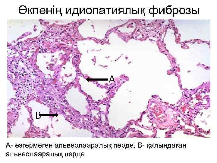 Өкпенің идиопатиялық фиброзы А В А- өзгермеген альвеолааралық перде, В- қалыңдаған альвеолааралық перде 